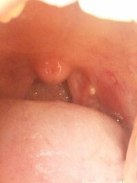 喉 の 奥 白い 粒