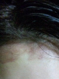 ヘアカラーで肌が赤くなって痒いです今までこんなことなかったのに Yahoo 知恵袋