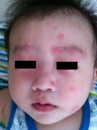 9ヶ月の子供にミルクをあげると 眉毛のあたりが赤くなります 毎回な Yahoo 知恵袋
