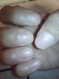 こんな爪でもサロンでケアしてもらえますか アトピーで引っ掻いて Yahoo 知恵袋