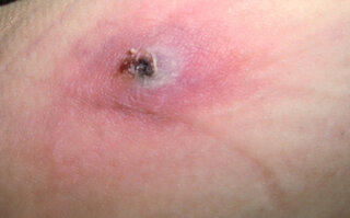 頭皮 吹き出物 病気 1253