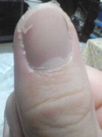 爪割れを治す方法でお聞きします 最近 親指の爪が端から割れて 亀裂が拡が Yahoo 知恵袋