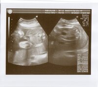エコーの赤ちゃんの性別の見分け方について聞きたいです 写真を見 Yahoo 知恵袋