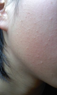 排泄物 信号 地元 顔 の ブツブツ 洗顔 Omutamachikyo Jp