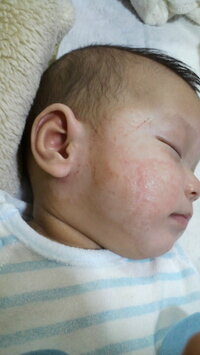 赤ちゃんの肌の色について双子のお兄ちゃん 生後４ヶ月になります 生まれた Yahoo 知恵袋