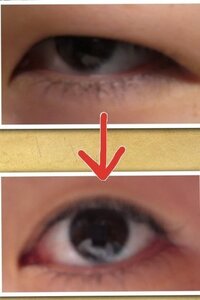 眉下切開について 閲覧ありがとうございます 現在高校生の Yahoo 知恵袋