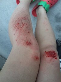 今日バイクでこけてしまい 両足 左ひじを怪我しました すり傷とかなのです Yahoo 知恵袋