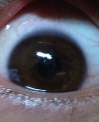 黒目の上が白く濁っています アカントアメーバ角膜炎でしょうか それと Yahoo 知恵袋