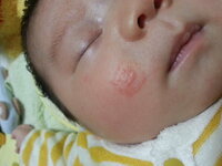 生後１ヶ月の息子の顔や頭皮に乳児湿疹と思われる赤や白いブツブツが２週間程前から Yahoo 知恵袋