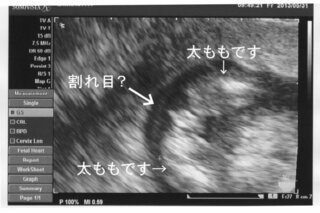 13週です エコー写真で性別判断お願いします 第二子妊娠中です 先日 Yahoo 知恵袋