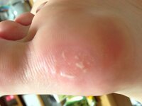 水ぶくれの中に 白い点 かたまりがいくつかあるのですか 皮膚科に行ったほう Yahoo 知恵袋