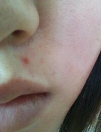 潰した後のニキビについて 先ほどニキビを潰してしまい たくさ Yahoo 知恵袋