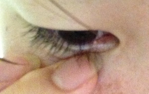 の でき もの まぶた ふち 白い 眼瞼の腫瘍
