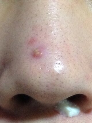 逃す 控えめな ペナルティ 黒 ニキビ パック ffordabletowingboise Com