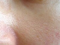 頬の毛穴がみえてしまいまって困っています 写真の様に毛穴がみえてしまい 綺 Yahoo 知恵袋