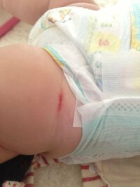 赤ちゃん生後4ヶ月の娘がさっき気付いたら太ももに赤く傷 みたいものが出来て Yahoo 知恵袋