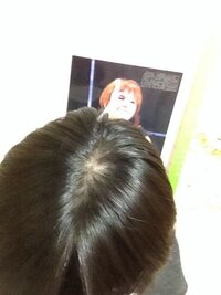 中学生女子です まだ若いはずなのに頭頂部がはげて来ました 考えら Yahoo 知恵袋