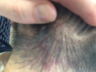 首筋にニキビのようなできものができます 首筋の後頭部辺りに Yahoo 知恵袋