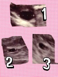 妊娠初期の者です 5週4日で何も見えず 7週目でやっと胎嚢1cm Yahoo 知恵袋