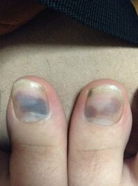 足の親指の爪の中 が紫色になっています 一週間ほど前 ブーツ Yahoo 知恵袋
