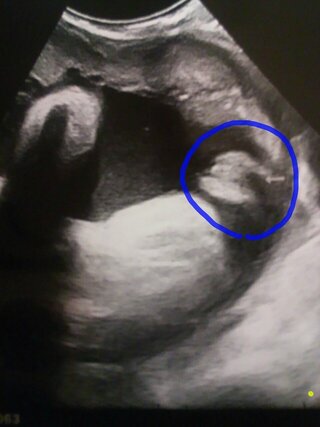 妊娠9ヶ月胎児のおまたのエコー写真です 性別判断お願いしますm M Yahoo 知恵袋