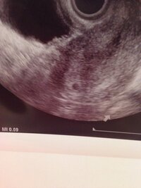 胎嚢画像あり 今日胎嚢を確認してもらったのですがネットなどで見る Yahoo 知恵袋