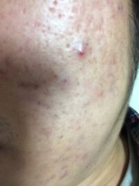 閲覧注意絶望的だとわかっていますが 私は長年クレーターに悩まされていま Yahoo 知恵袋