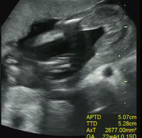 妊娠22週性別について 性別判定お願いします このエコー写真は女の子でし Yahoo 知恵袋
