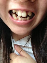 私は 歯がガタガタで前歯がビーバーみたいにでています こん Yahoo 知恵袋