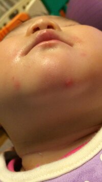 赤ちゃんの湿疹について11ヶ月の子どもがいます最近 色々な場所にニキビのよ Yahoo 知恵袋