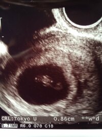 妊娠7週エコー写真の見方についてこんにちわ 妊娠7週目の初妊婦です 土曜日 Yahoo 知恵袋