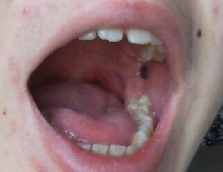 口 の 中 血豆