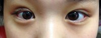 生後２ヶ月の赤ちゃんの顔に青い血管があります 眉間の所に2センチくらいの青い血 Yahoo 知恵袋