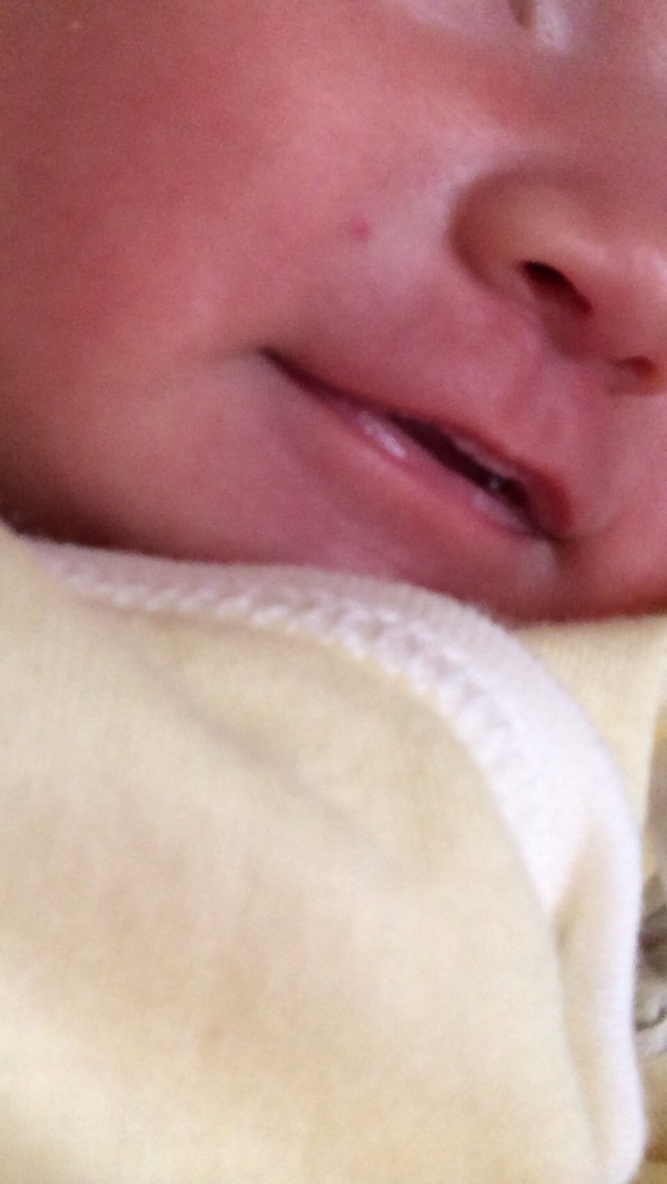 新生児赤いデキモノ。朝起きたら赤ちゃんのホッペに赤いぽつッとした 