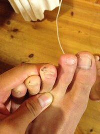 相談です 二ヶ月程前から両足の中指と薬指の殆ど同じ所に黒いホクロか血豆のよ Yahoo 知恵袋