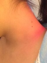 小さい頃から首にほくろが2つあります あまりほくろが２つならんでいる人を見 Yahoo 知恵袋