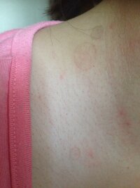 首筋にこのような 画像参照 斑点 丸いしみのような あざのような Yahoo 知恵袋