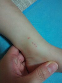 昨日から子供の足や手に湿疹が出来ています 旦那にも同じような湿疹が出来てい Yahoo 知恵袋