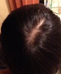 高校生です つむじ周りなんですけど薄いですよね まだ17に Yahoo 知恵袋