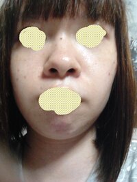 閲覧ありがとうございます いきなりですが ほくろが多いのが悩みです 顔は一 Yahoo 知恵袋