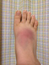 足の甲をぶつけてしまいました ノd はじめは腫れていまし Yahoo 知恵袋