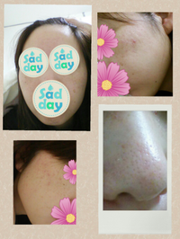 グロ画像注意 何年もの間 顔のニキビ ぶつぶつや毛穴 Yahoo 知恵袋