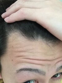 生え際気になってきています 片方は普通なのですが片方だけ後退して Yahoo 知恵袋