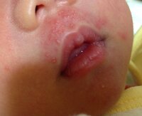 生後2週間の新生児の吹き出物について 初産で現在生後2週間の男の Yahoo 知恵袋