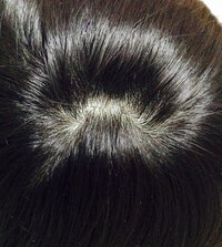 閲覧注意 画像ありつむじが２つあります 親の遺伝で画像の Yahoo 知恵袋