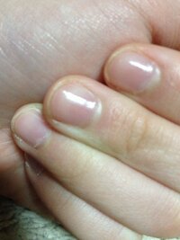 この爪で ネイルシール貼ったら おかしいですか それとももうちょっと 伸ば Yahoo 知恵袋