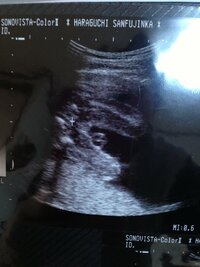 妊娠w3dの股下からのエコー写真です 女の子の特徴も男の子の特徴も自分 Yahoo 知恵袋