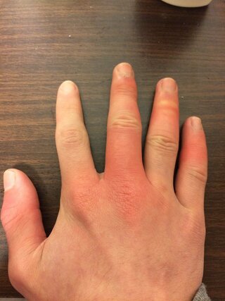 リュウマチに詳しい方お願いします 3日前に突然小指が腫れだし 突き指だと思 Yahoo 知恵袋