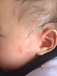 4ヶ月半の息子の耳たぶの下が最近切れてます 右耳だけです 左耳は普通の肌で乾 Yahoo 知恵袋