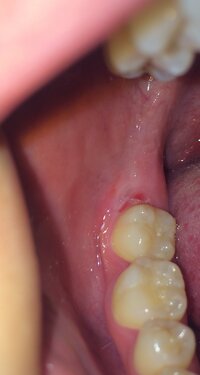 気づいたら奥歯の歯茎が赤く腫れてるorz親知らずの前兆 歯医者に Yahoo 知恵袋